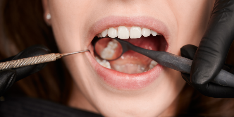 Dental Crowns and Bridges