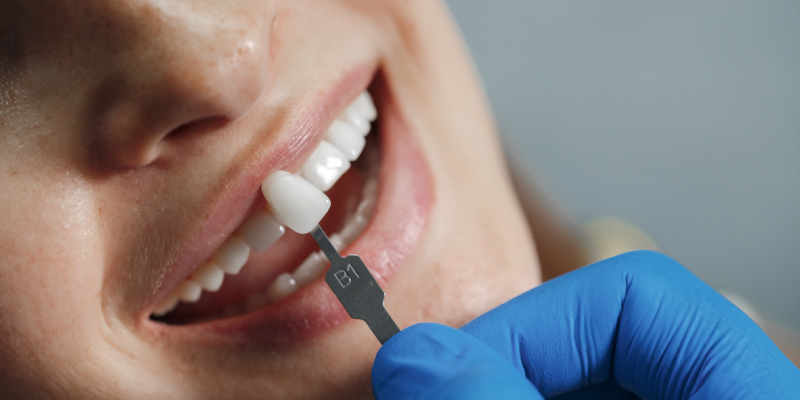 Dental Veneers Treatment