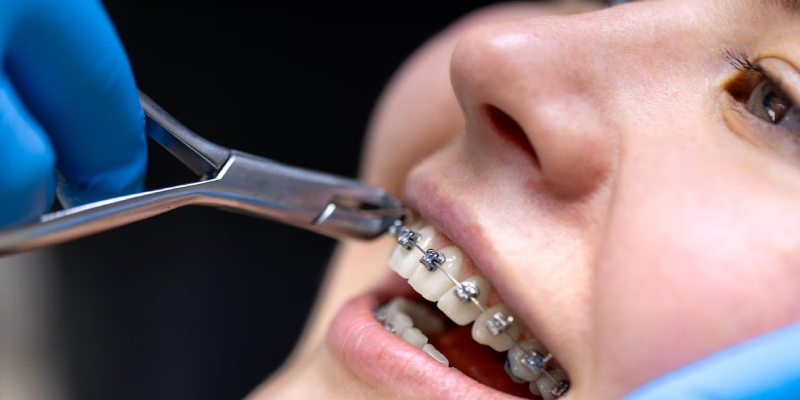 Orthodontic Treatment