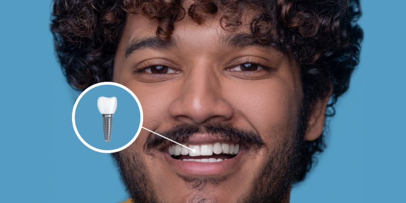 Single Dental Implant