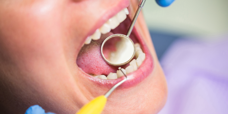 Tooth Colored Fillings